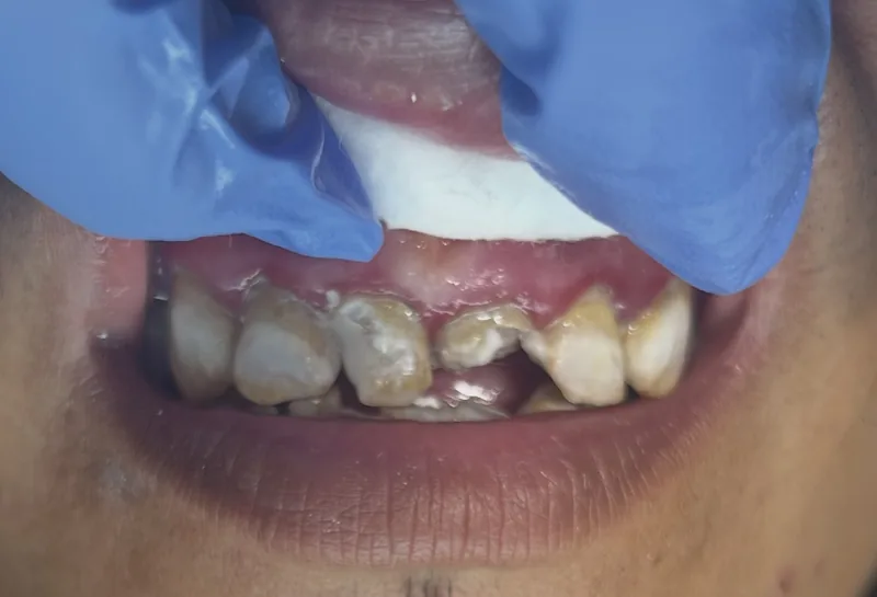 Antes: coronas anteriores y reconstrucción en NK Art Estudio Dental Querétaro