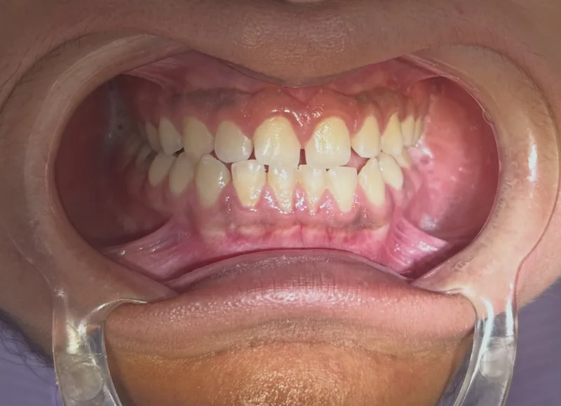 Antes: limpieza y aclaramiento en NK Art Estudio Dental Querétaro